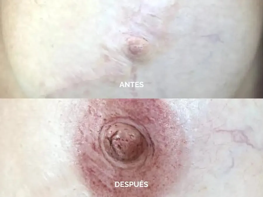 Segundo caso: antes y después de una reconstrucción de areola-pezón