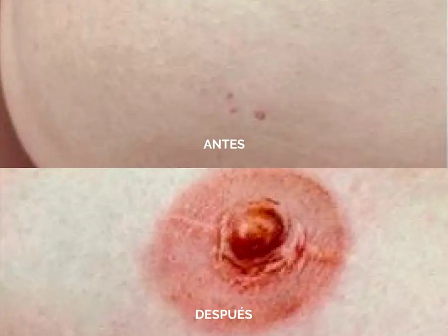 Antes y después de una reconstrucción de areola-pezón