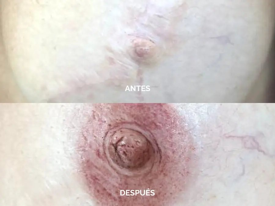 Antes y después de una reconstrucción de areola-pezón