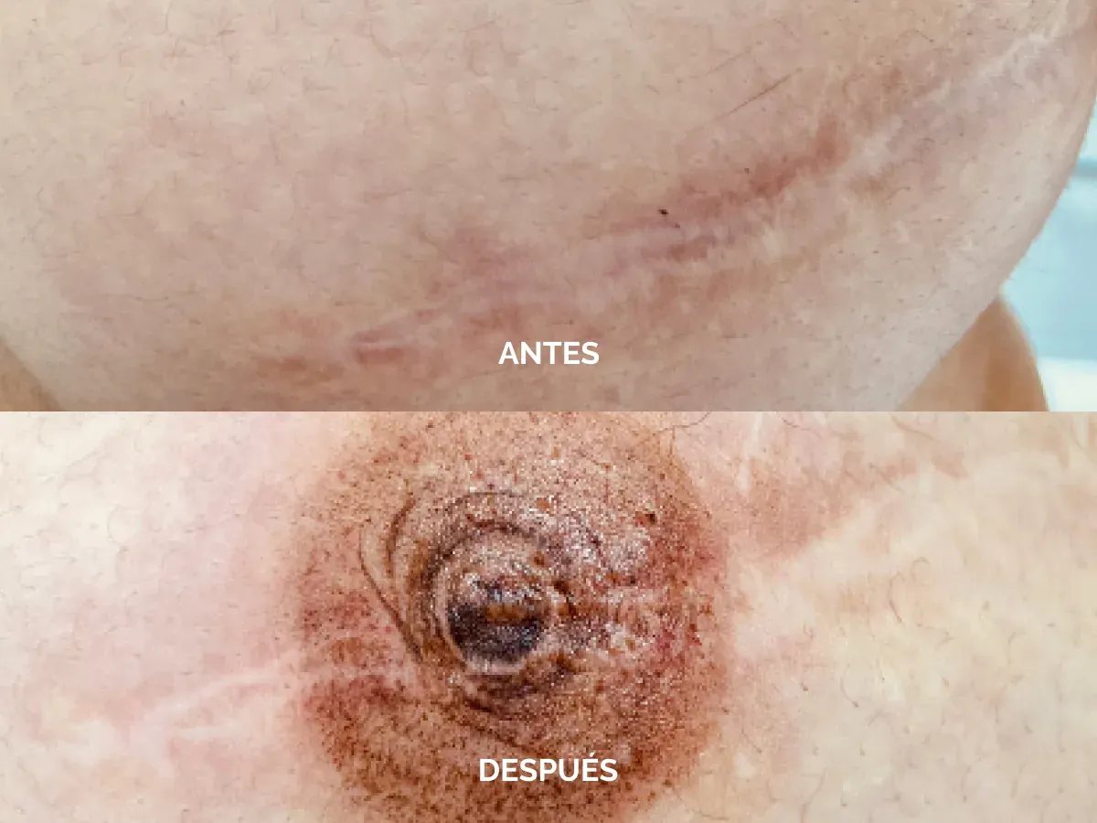 Resultado antes y después de una reconstrucción de areola